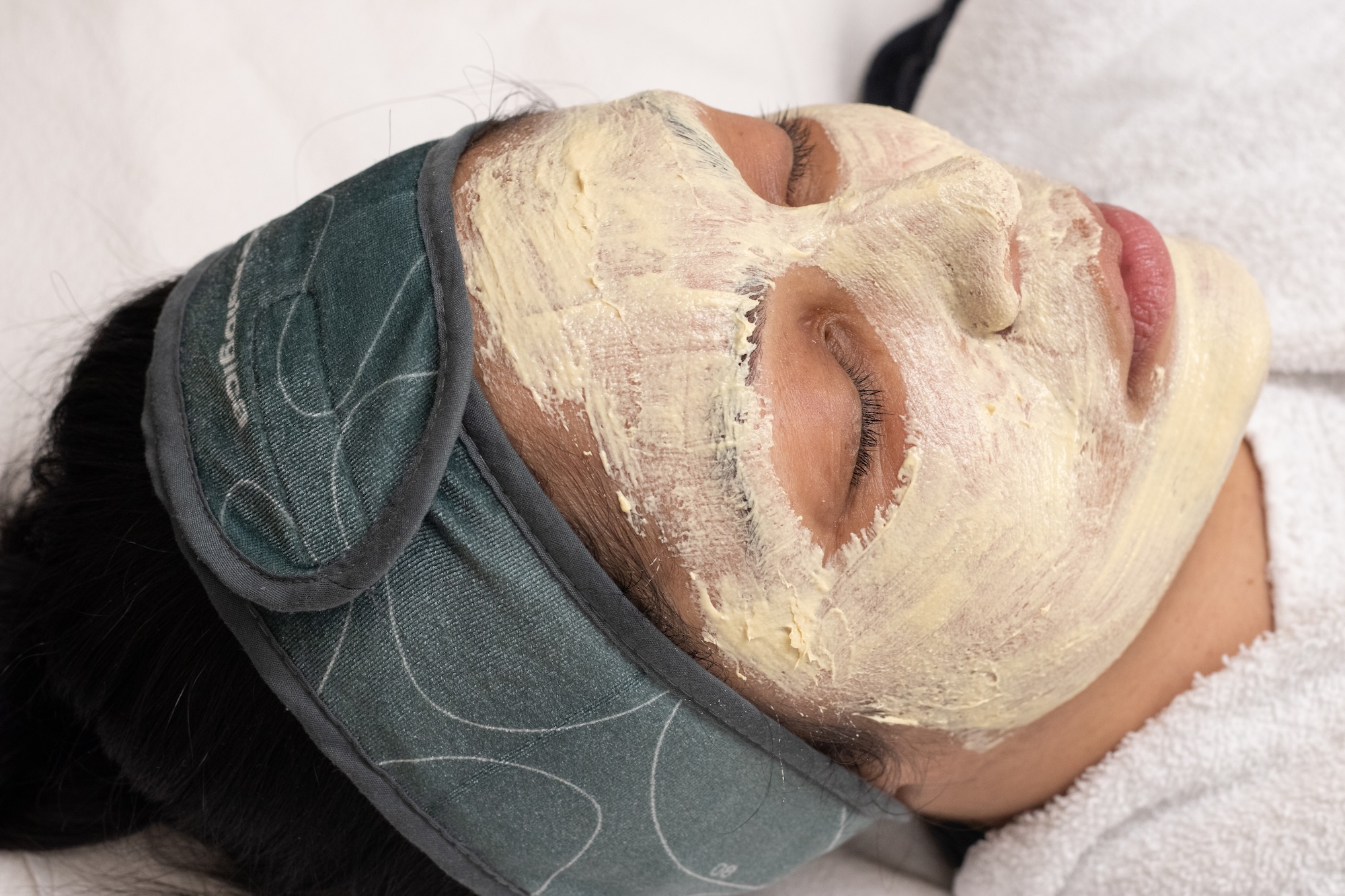 A close-up of a patient with a Melano-Pro Peel applied to her face.
