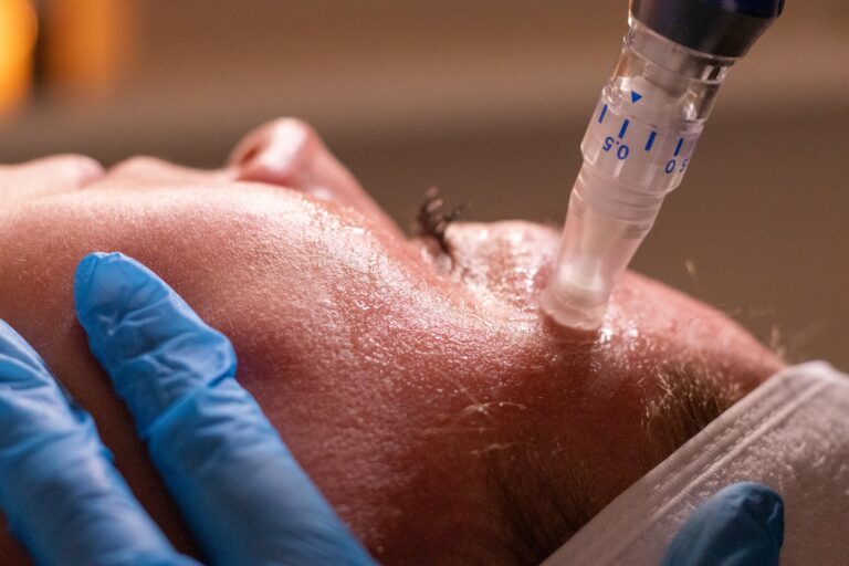 Close-up of a patient's face as a microneedling device exfoliates her skin.