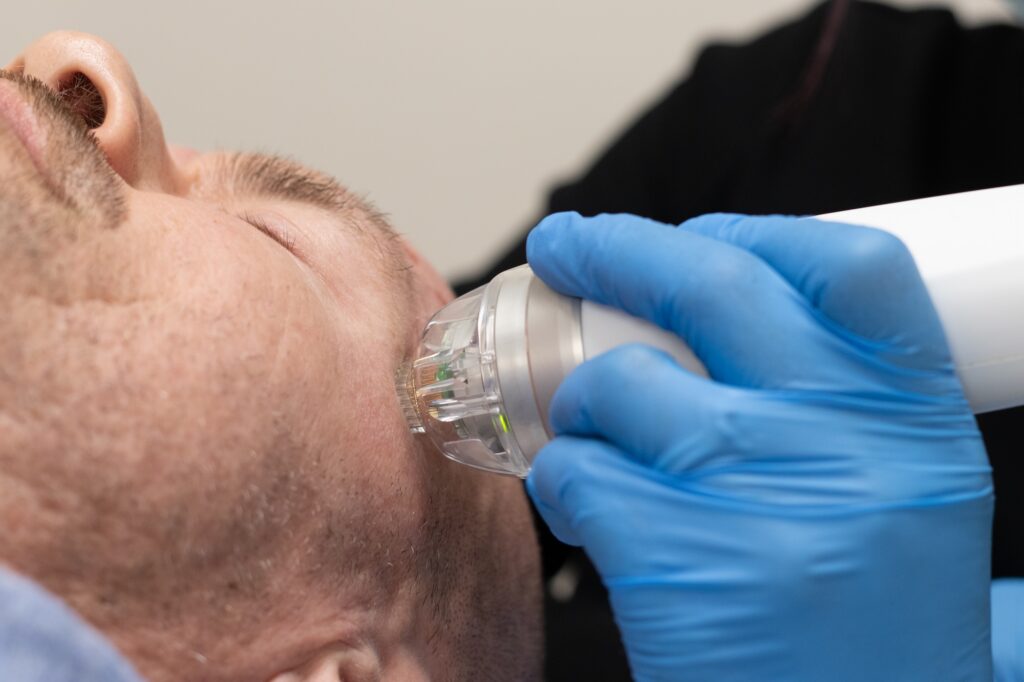 A close-up of a man's face receiving microneedling at GraceHill Salon and Spa in Winnipeg